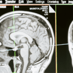 Diet and Preventing Strokes